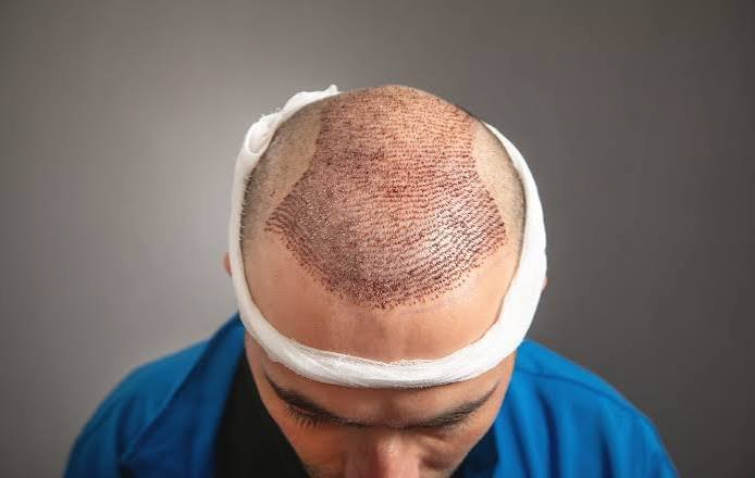 Hair Transplant Recovery Stages, Healing Process, and Best Practises
