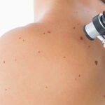 What Is a Full Body Skin Check and Why Does It Matter