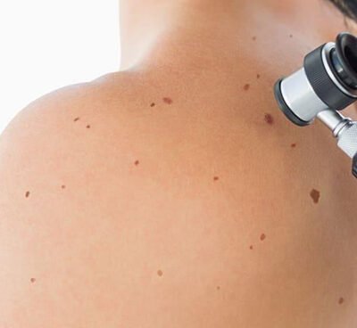 What Is a Full Body Skin Check and Why Does It Matter