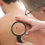 skin cancer treatment gold coast