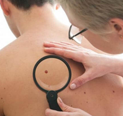 skin cancer treatment gold coast